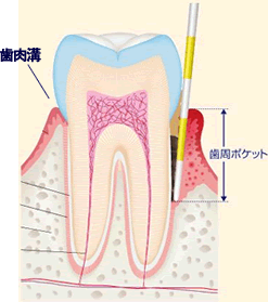 歯周病とは?