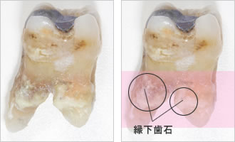縁下歯石