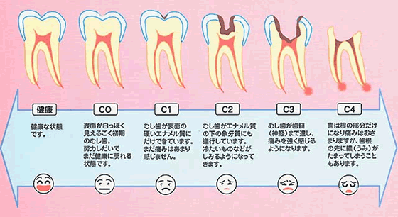 虫歯を放っておくとどうなるのか?